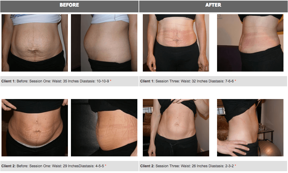 Before & After Diastasis