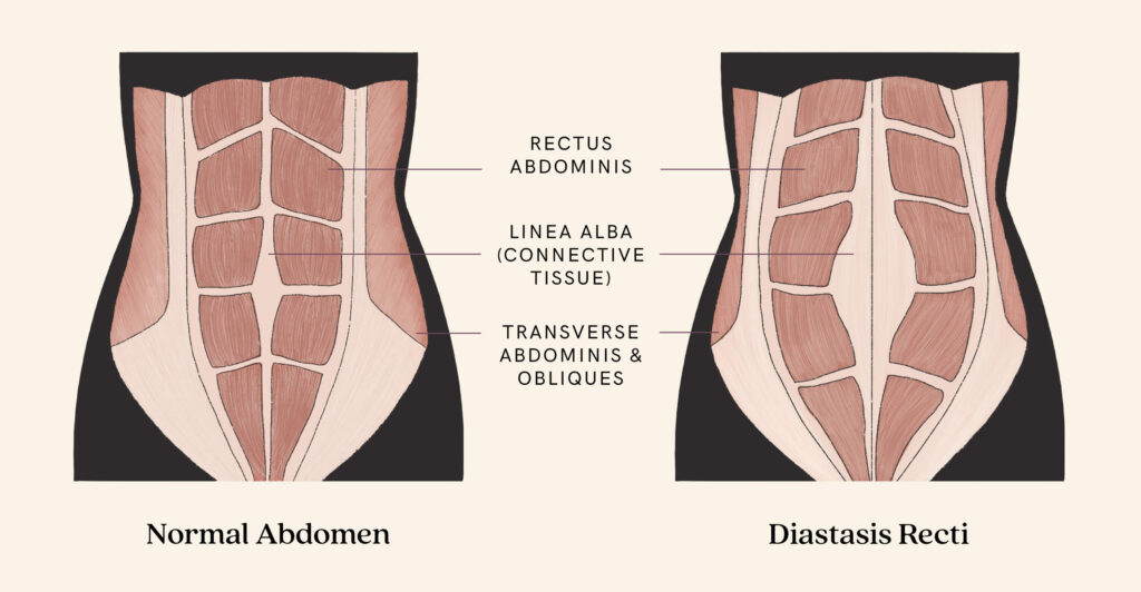 diastasis recti diagram