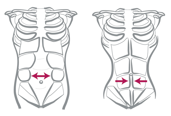diastasis recti