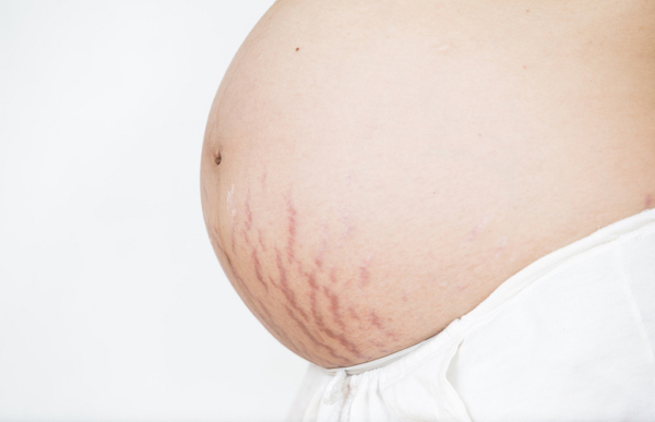 stretch marks